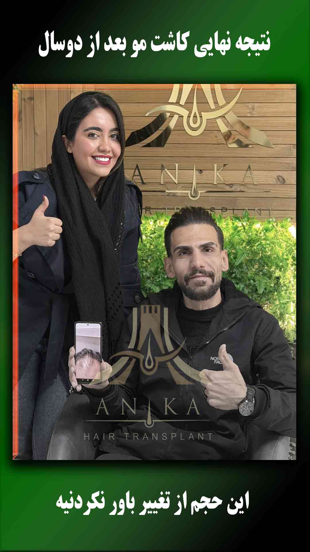 کاشت مو بعد از دوسال 